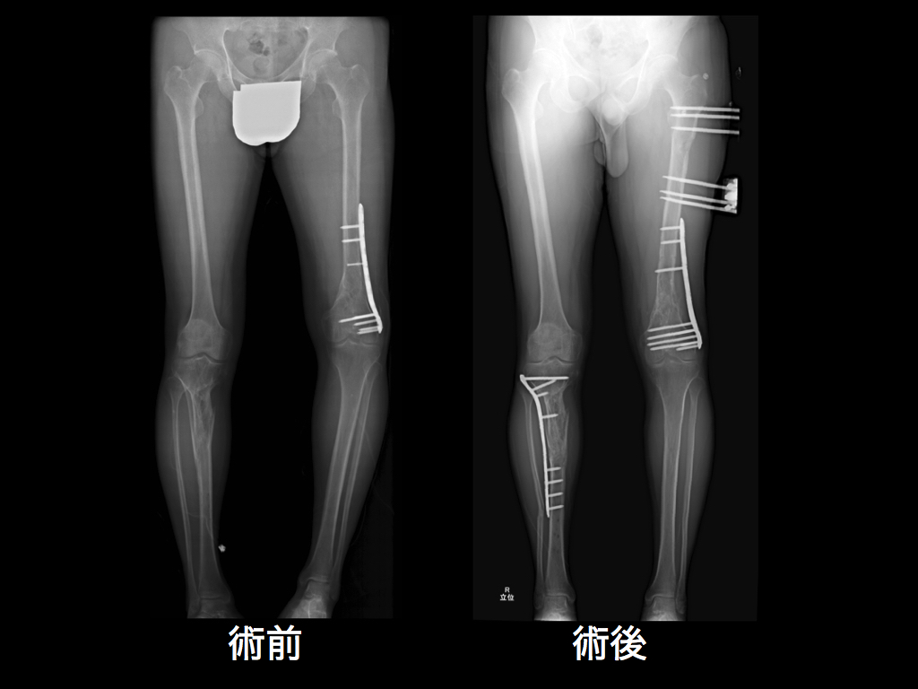 骨折 と は 粉砕